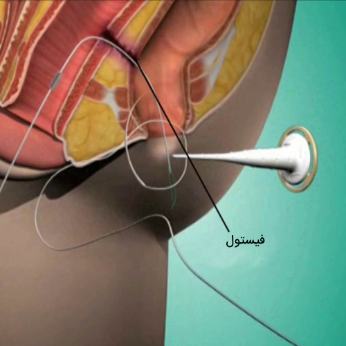 فیستول مقعدی | درمان فیستول مقعد با لیزر در کلینیک پایتخت