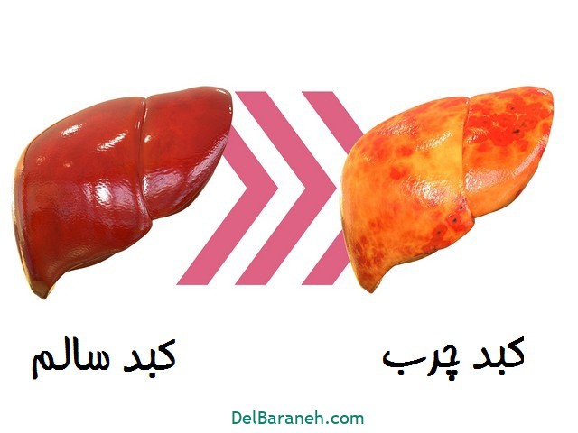 درمان قطعی کبد چرب ، بیماری خاموش! عکس شماره 2