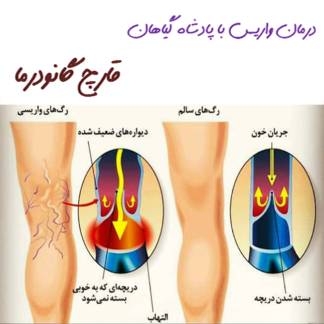 درمان خانگی واریس :)