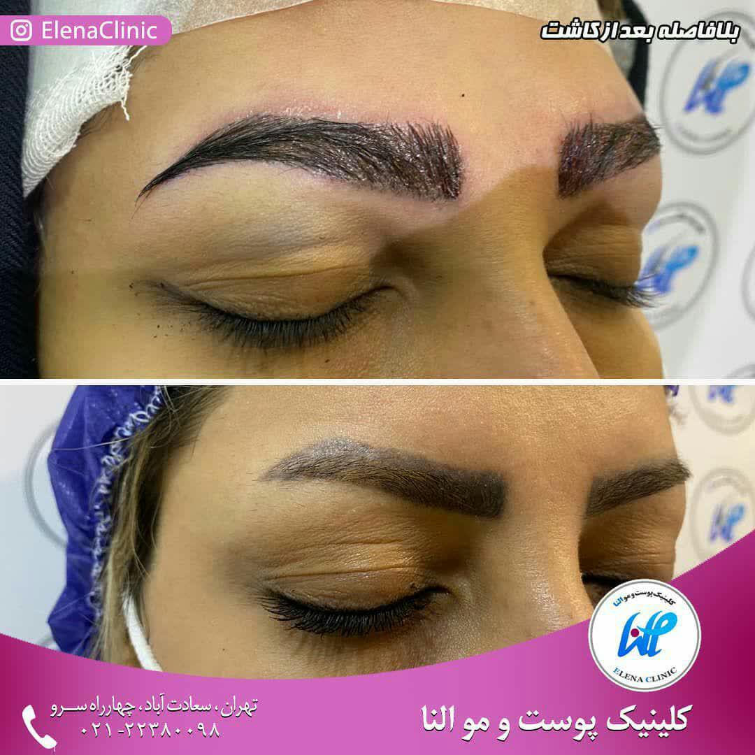 کاشت ابرو مناسب افرادی که ابروهای کم پشتی دارند