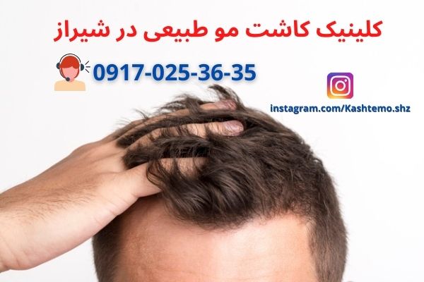 کاشت موی طبیعی در شیراز عکس شماره 1