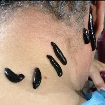 اموزش طب سوزنی حجامت و زالو