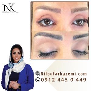 ریموو تاتو قدیمی در بهترین مرکز ریموو تاتو