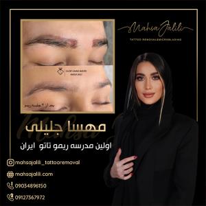 آموزش ریموو تاتو ابرو با جدیدترین روش
