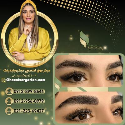 میکروبلیدینگ غزل زرگریان در تهران