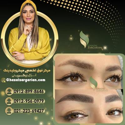 میکروبلیدینگ غزل زرگریان در تهران