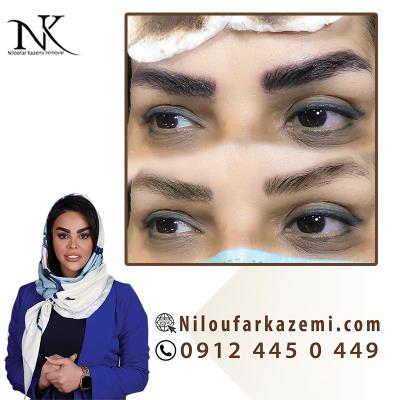 ریموو تاتو قدیمی در بهترین مرکز ریموو تاتو