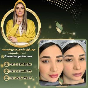 میکروبلیدینگ غزل زرگریان در تهران